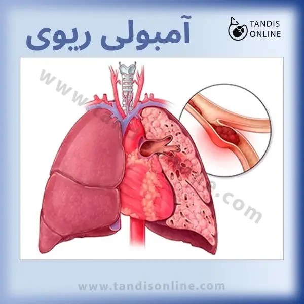 آمبولی ریه : علائم پیشگیری و درمان با استفاده از اکسیژن ساز