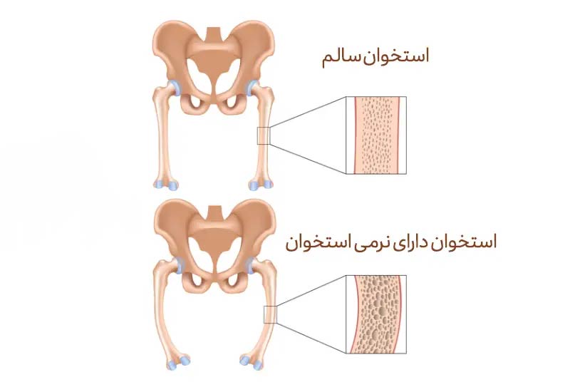 نرمی استخوان چیست؟ علائم، علل ابتلا و نحوه درمان آن
