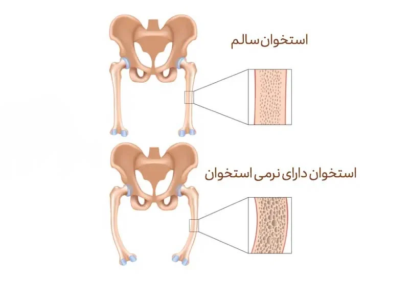 بیماری نرمی استخوان چیست؟ علائم، علل ابتلا و نحوه درمان آن