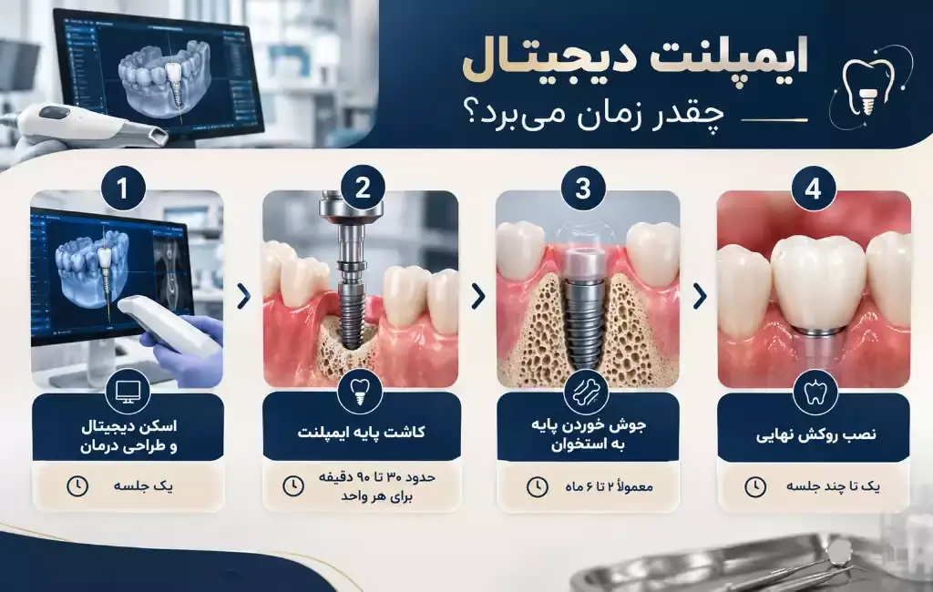 ایمپلنت دیجیتال چقدر زمان میبرد؟